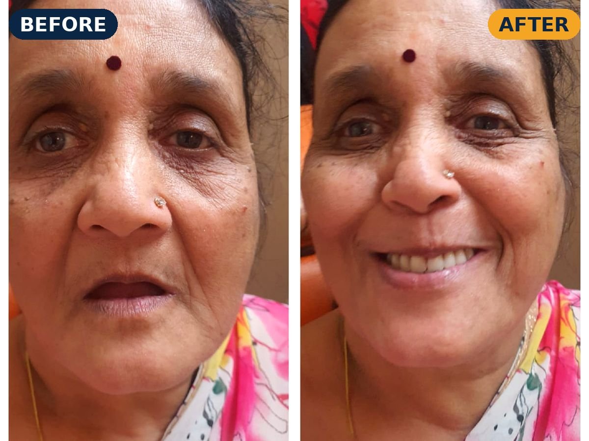 Before and after full-mouth rehabilitation of a senior patient